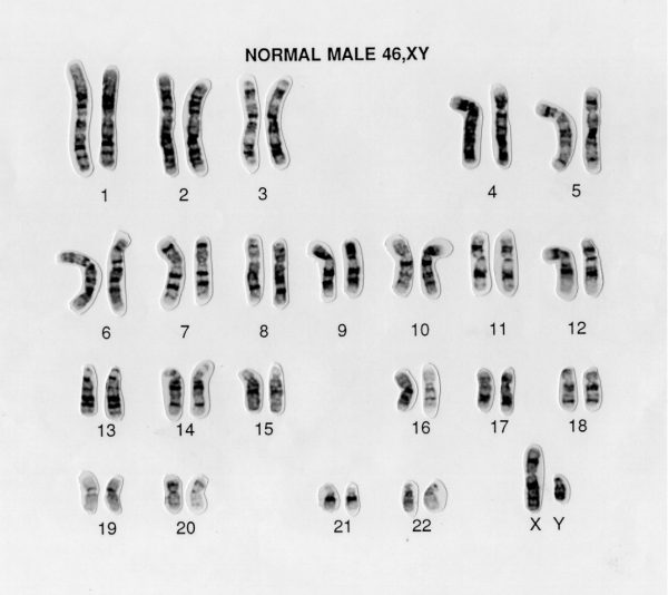 Trisomy 13/18 Chromosomes | Soft Ireland